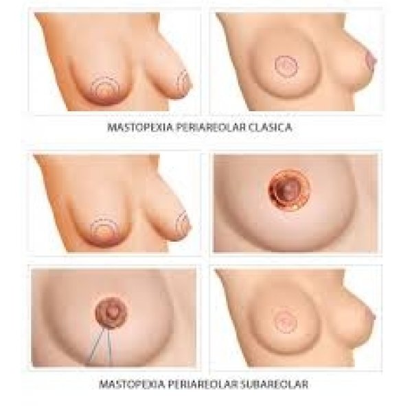 Cirurgia de Mastopexia em São Paulo
