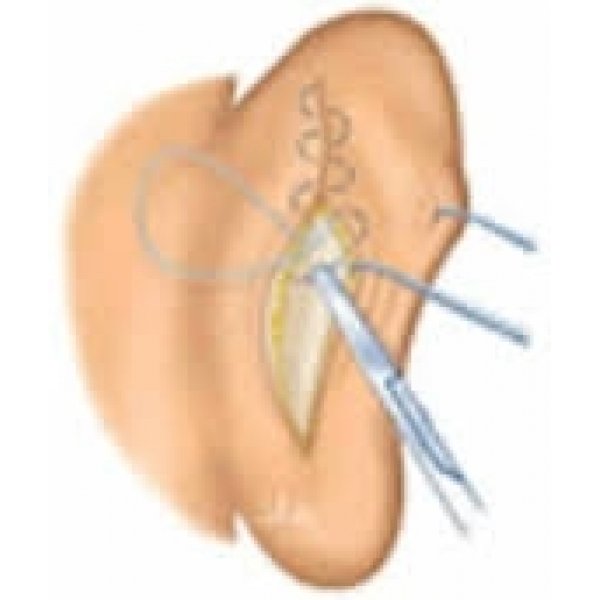 Cirurgia de Otoplastia na Avenida Paulista