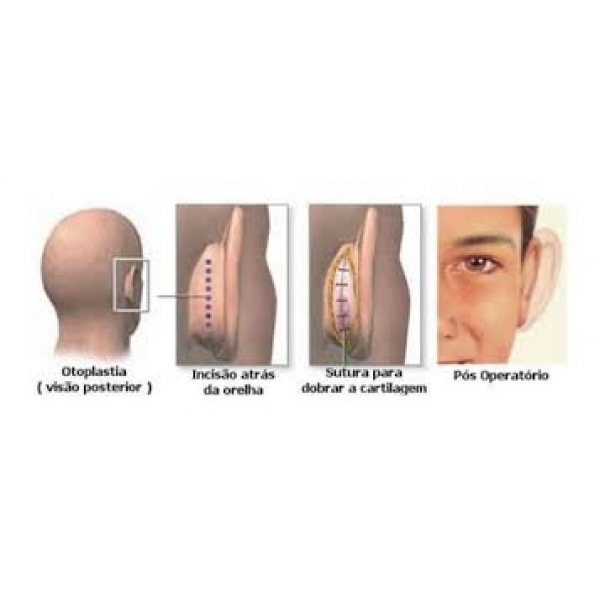 Cirurgia de Otoplastia no Centro