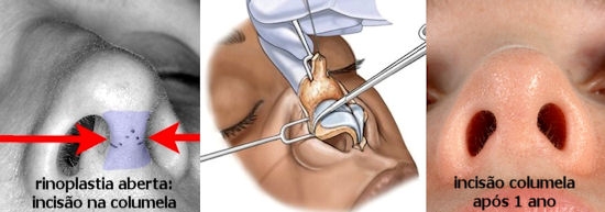 Clínica Estética de Rinoplastia