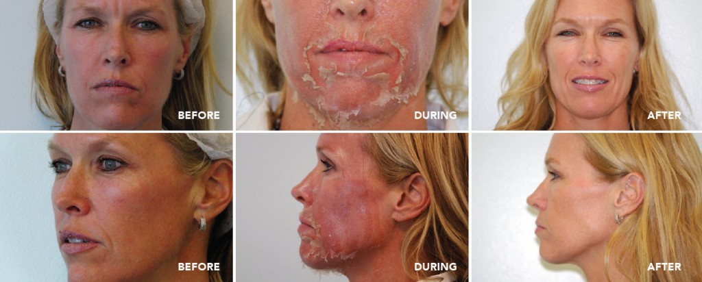 Clinicas de Peeling