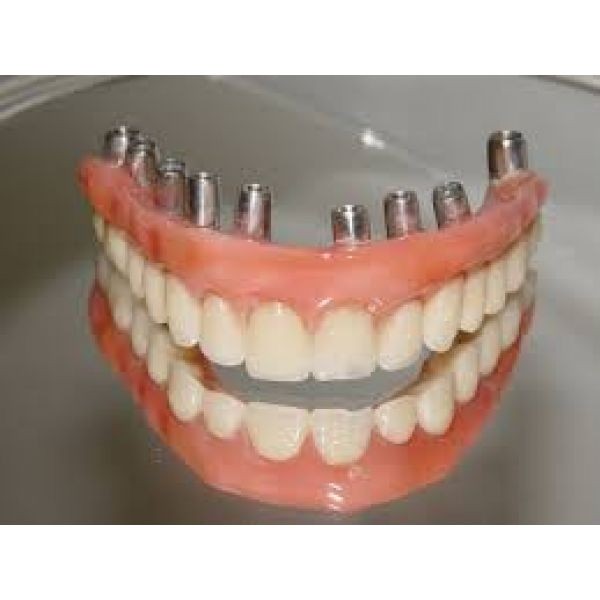 Implante Dental