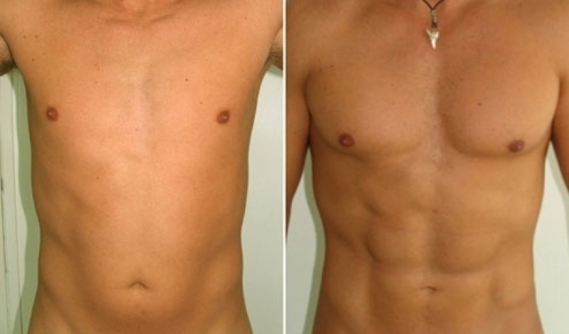 Lipoaspiração Abdominal