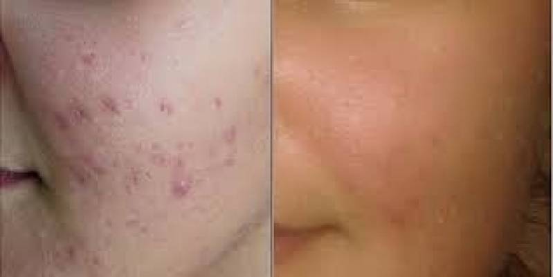 Peeling Químico para Acne