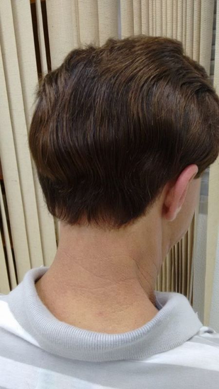 Prótese Capilar para Alopecia