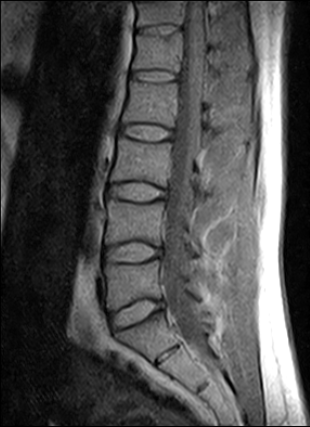 Ressonância Magnética Coluna Cervical Preço