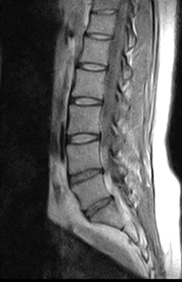 Ressonância Magnética Coluna Vertebral Preço