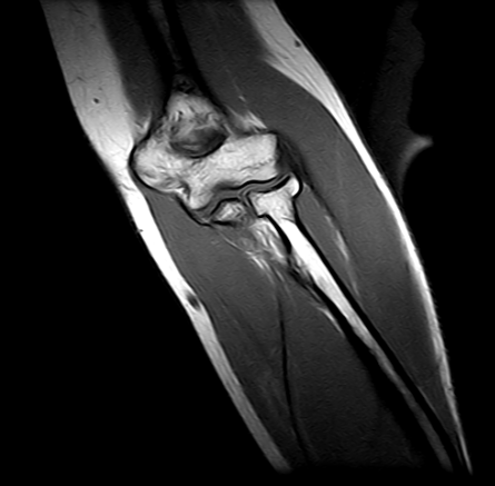 Ressonância Magnética Cotovelo Quebrado