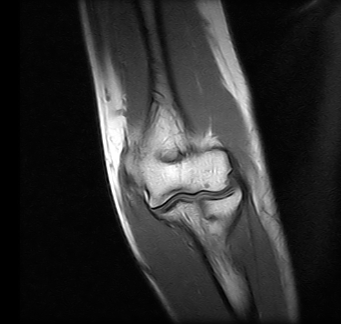 Ressonância Magnética de Cotovelo em São Bernardo