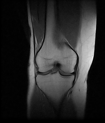 Ressonância Magnética para Joelho