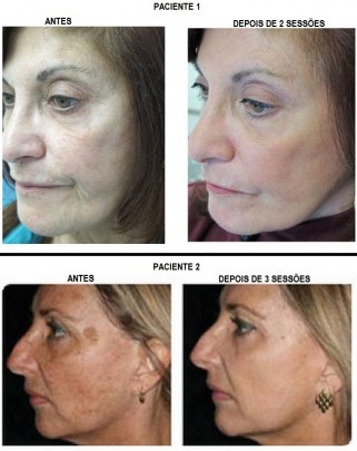 Tratamento de Pele Facial