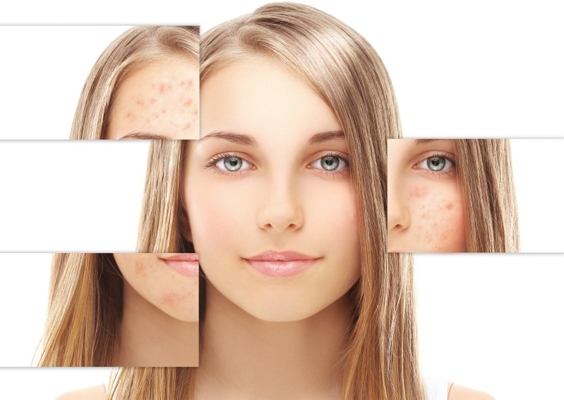 Tratamento Estético para Acne Grau 2