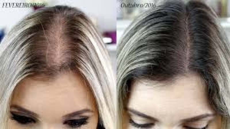 Tratamento para Crescer Cabelo