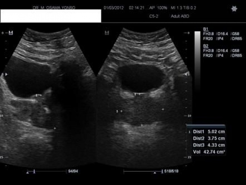 cancer de prostata ultrassonografia pregătire pentru îndepărtarea viermilor