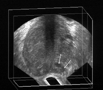 cancer de prostata ultrassonografia îndepărtarea verucilor genitale într- o singură zi