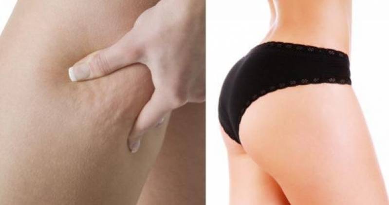 Velashape Tratamento para Celulite